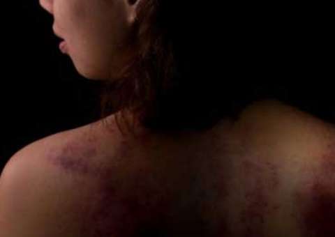 Homem ateia fogo em ex-mulher e vítima tem queimadura de 3º grau 