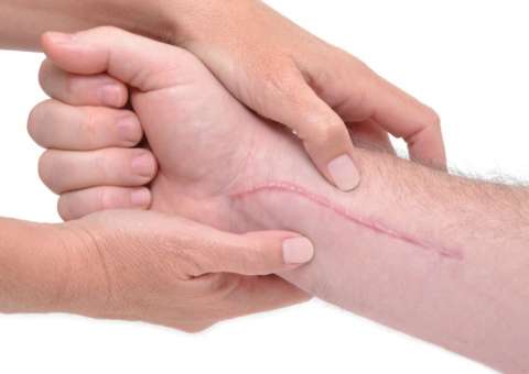 Conheça 7 remédios caseiros que ajudam na cicatrização 