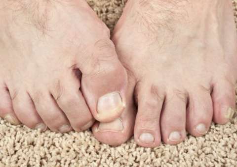 Remédios caseiros podem combater micoses de pele, unha e cabelos 