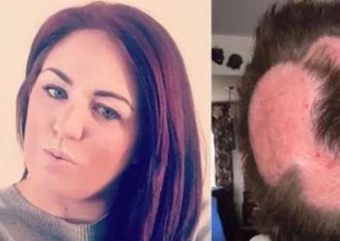 Mulher tenta ter 'cabelo de unicórnio' e acaba perdendo parte do couro cabeludo