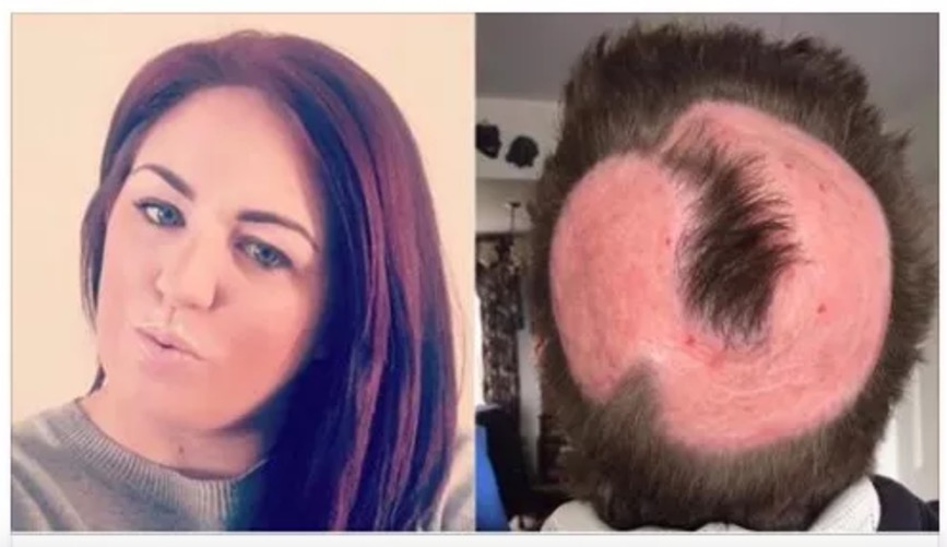 Mulher tenta ter 'cabelo de unicórnio' e acaba perdendo parte do couro cabeludo