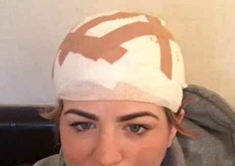 Mulher perde parte do couro cabeludo na tentativa de ficar na moda