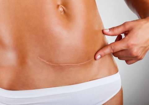 Mulheres que fazem cesárea têm dobro de chance de desenvolver dor durante o sexo, diz estudo