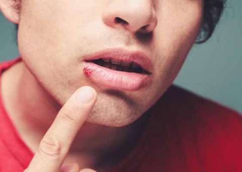 Espécie de Inhame é recomendada para combater herpes 