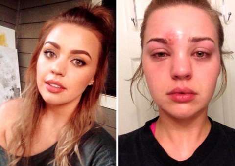 Jovem espreme espinha e acaba descobrindo grave problema de saúde 