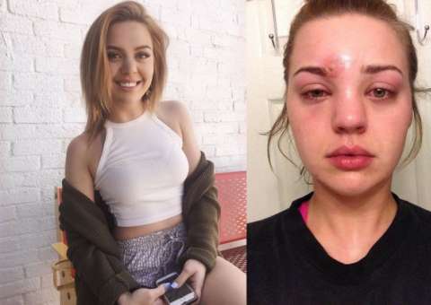 Jovem vai parar no hospital com infecção grave após espremer espinha