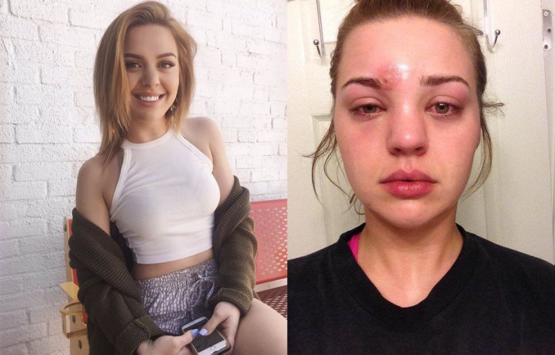 Jovem vai parar no hospital com infecção grave após espremer espinha