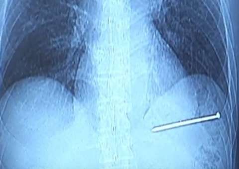 Homem dirige até hospital com prego cravado no coração