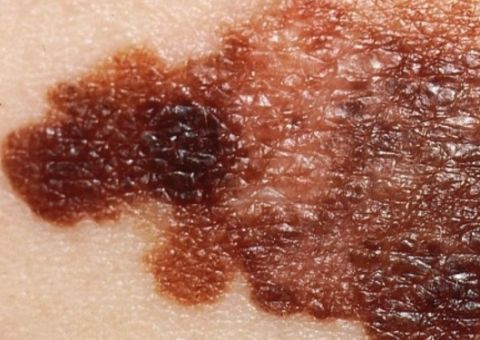 Falta de nutrientes leva célula tumoral a migrar pelo corpo, diz cientista