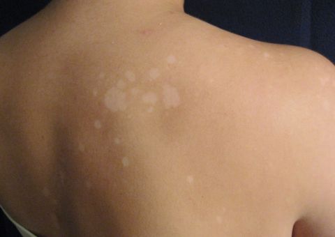 Tintura de planta é indicada para tratar impingem e pano-branco no rosto. Conheça   