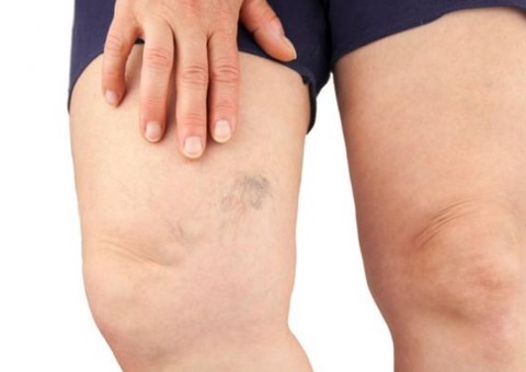 Tintura ou pomada de flor ameniza dores de varizes e furúnculos 