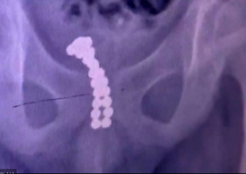 Por curiosidade, menino de 11 anos coloca 26 ímãs no pênis e o pior acontece