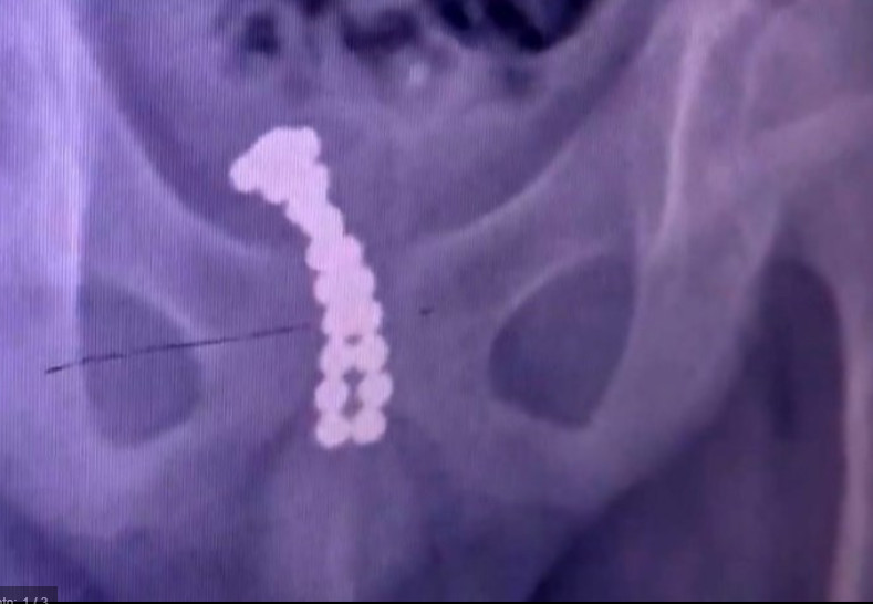 Por curiosidade, menino de 11 anos coloca 26 ímãs no pênis e o pior acontece