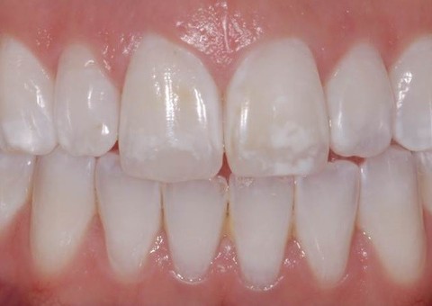 O que são as manchas brancas que algumas pessoas têm nos dentes?