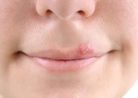 Conheça alimentos que podem auxiliar no combate ao vírus causador da Herpes 