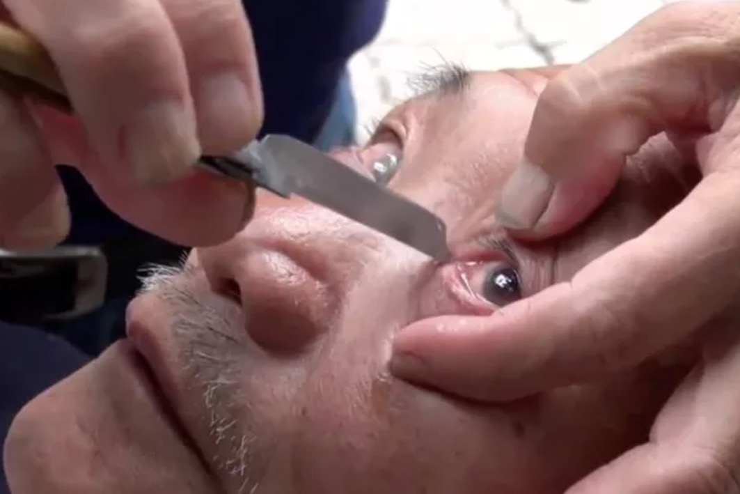 Homem ‘barbeia' globos oculares para limpar visão e técnica surpreende. Veja vídeo 