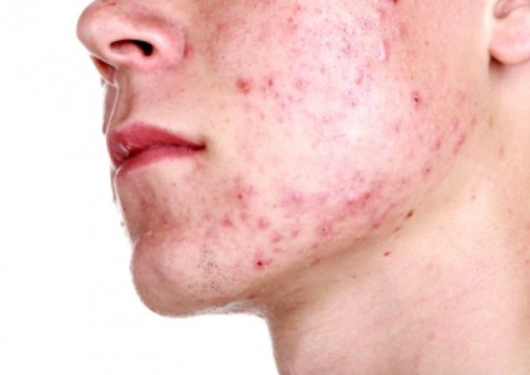 Gel feito de óleo de peixe trata espinhas, micoses, inflamações e abscessos. Conheça 