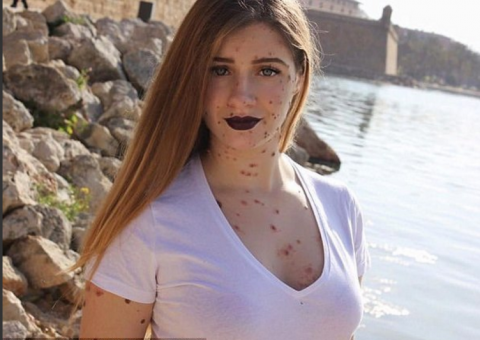 Jovem desiste de fazer cirurgias para remover pintas do corpo por um motivo