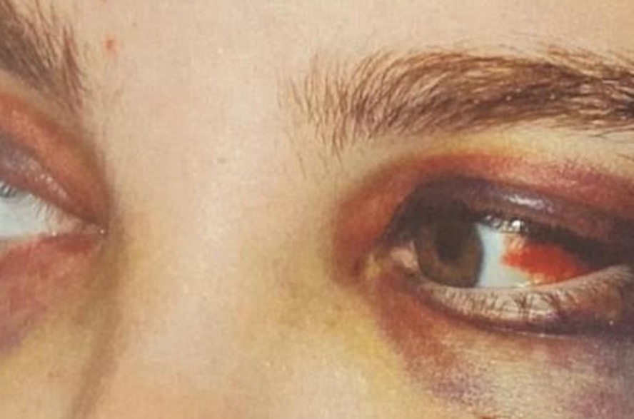 Babá é obrigada a tomar desinfetante após ser torturada por patrões 