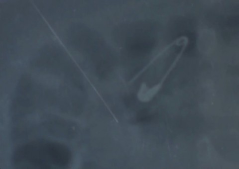 Bebê de seis meses engole alfinete aberto que prendia chupeta 