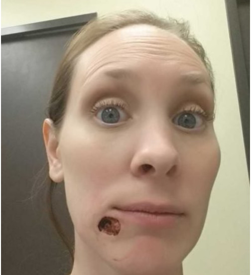 Mulher pensa que é simples cravo, mas descobre que volume no queixo é câncer 