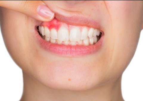 Chá de erva pode combater gengivites e inchaços.Conheça 