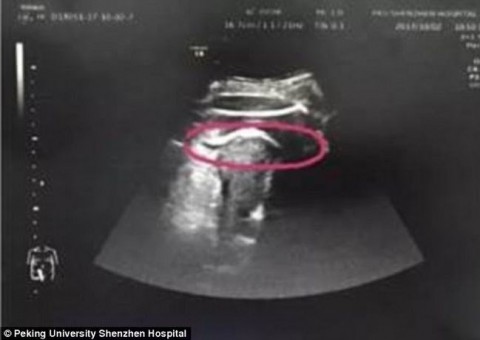 Bebê ainda no ventre, dá chute tão forte que perfura útero da mãe 