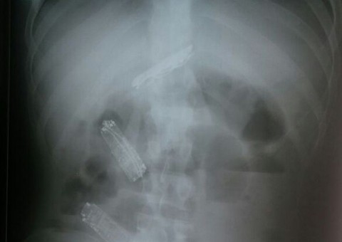 Presidiário tenta esconder três celulares no estômago e algo terrível acontece