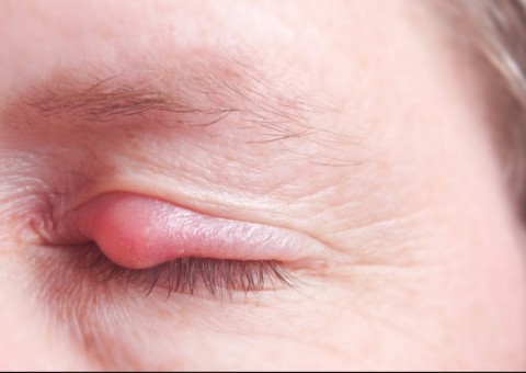 Semente de fruta pode combater terçol. Conheça 