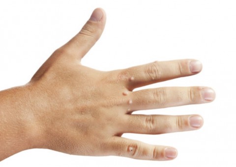 Leite de planta pode ser usado contra verrugas e abcessos na pele 