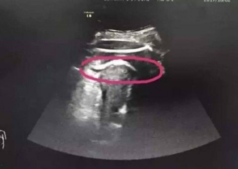 Mulher grávida quase morre após ‘chute’ do bebê romper o útero