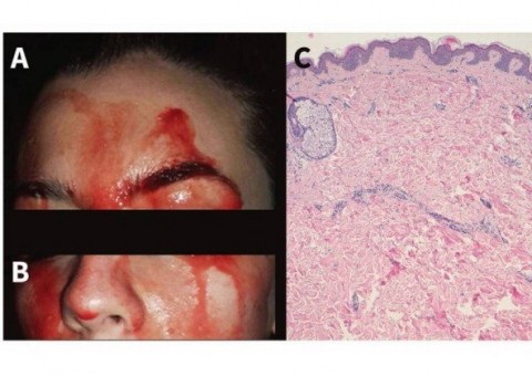 Condição rara faz jovem italiana ‘suar sangue’