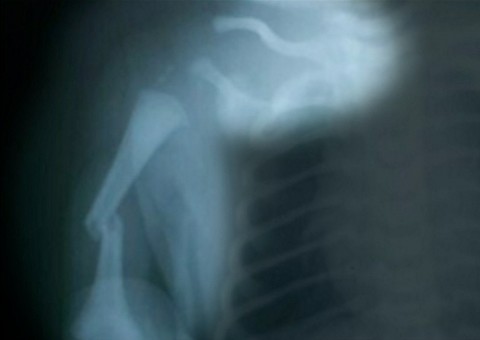 Bebê tem braço e clavícula quebrados durante parto 