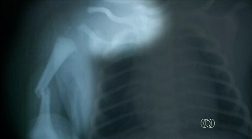 Bebê tem braço e clavícula quebrados durante parto 