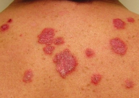 Compaj realiza ação de prevenção contra doenças de pele