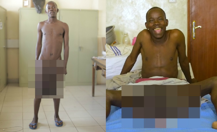 Após postar foto no Facebook, homem com maior pênis do mundo faz cirurgia de redução