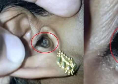 Mulher descobre algo no ouvido o que causava dor de cabeça