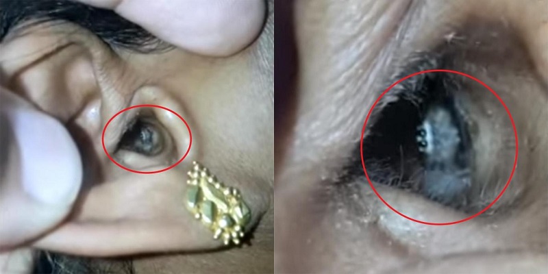 Mulher descobre algo no ouvido o que causava dor de cabeça