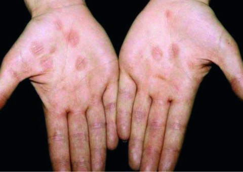 Casos de sífilis em adultos aumentam 27,9% em um ano