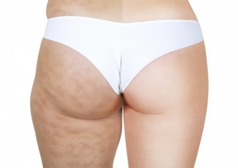 Para reduzir a celulite aposte nessas dicas de alimentação 