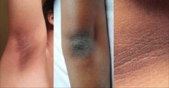 Elimine de vez manchas escuras na virilha e axilas 