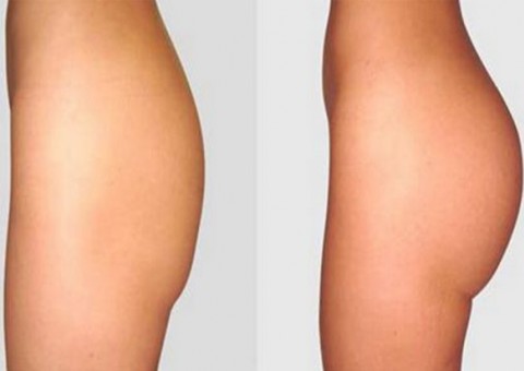 Aprenda a aumentar e tonificar o bumbum de forma natural com creme feito em casa