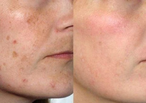 Elimine de vez manchas na pele com receita feita em casa