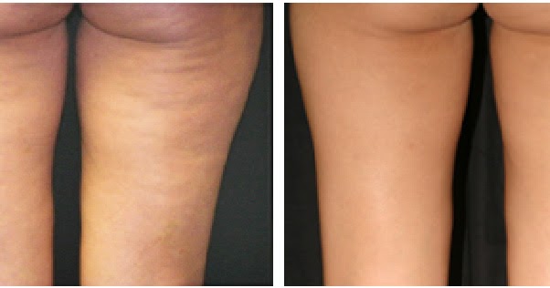 Conheça o chá que vai eliminar suas celulites 