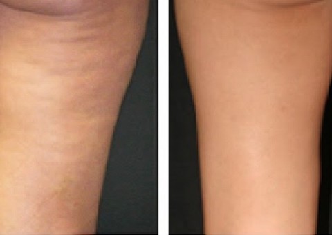 Conheça o chá que vai eliminar suas celulites 