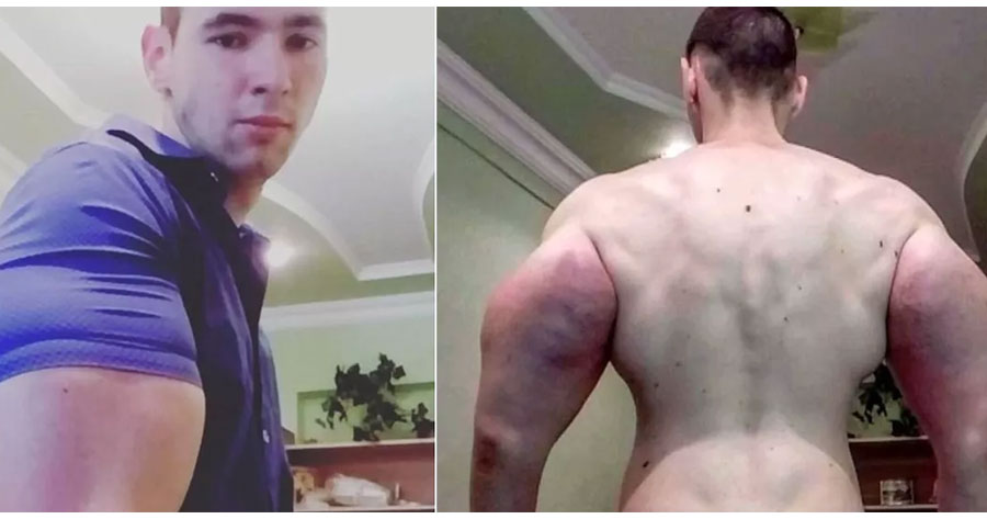   Homem injeta óleo no corpo para ficar sarado e mostra resultado chocante na internet