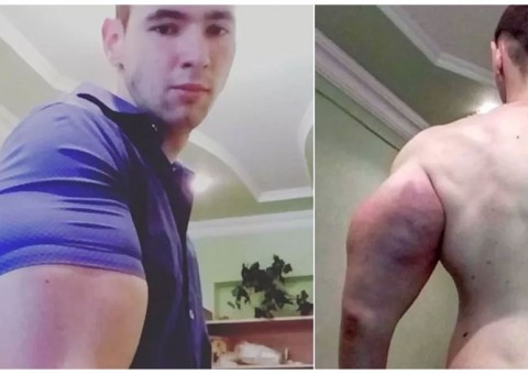   Homem injeta óleo no corpo para ficar sarado e mostra resultado chocante na internet