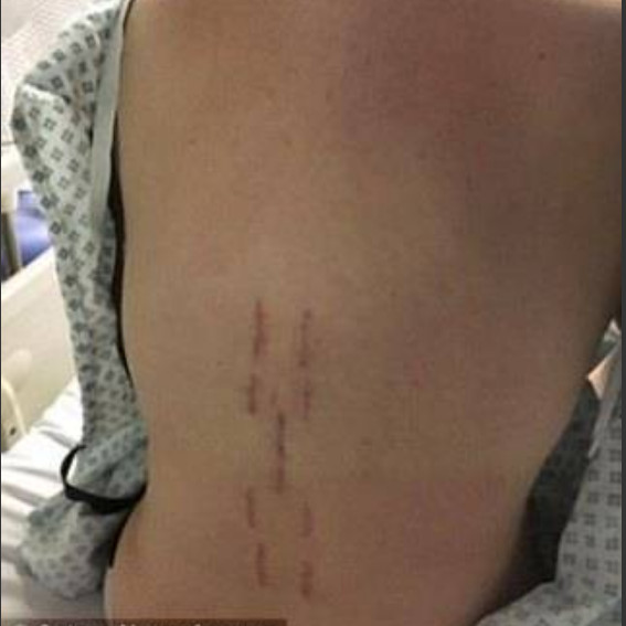 Fanática por malhar fica na cadeira de rodas após acidente na academia