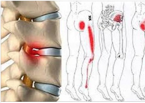 Forma simples e barata para eliminar definitivamente dor no nervo ciático