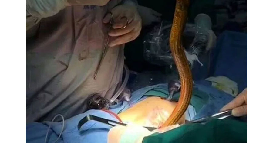 Homem vai parar no hospital com enguia enfiado no próprio ânus